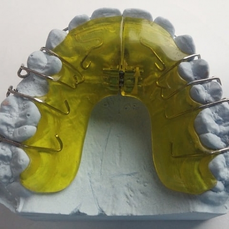 Colored Braces - Beach Braces - Orthodontic Specialists