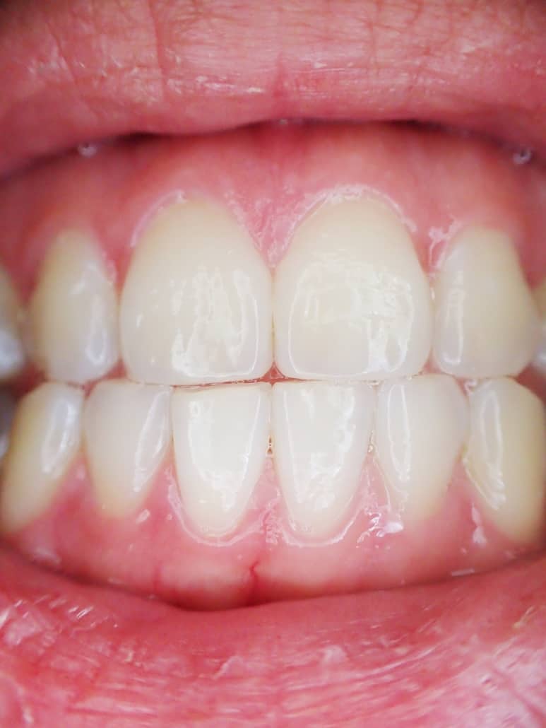 Does Invisalign Cause Gum Recession? Invisalign Bleeding?