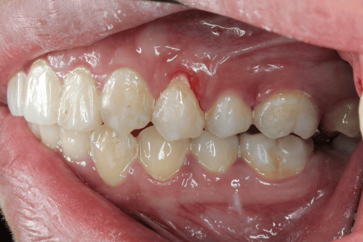 Can Invisalign Cause Gum Recession? (We Answer) - Beach Braces ...